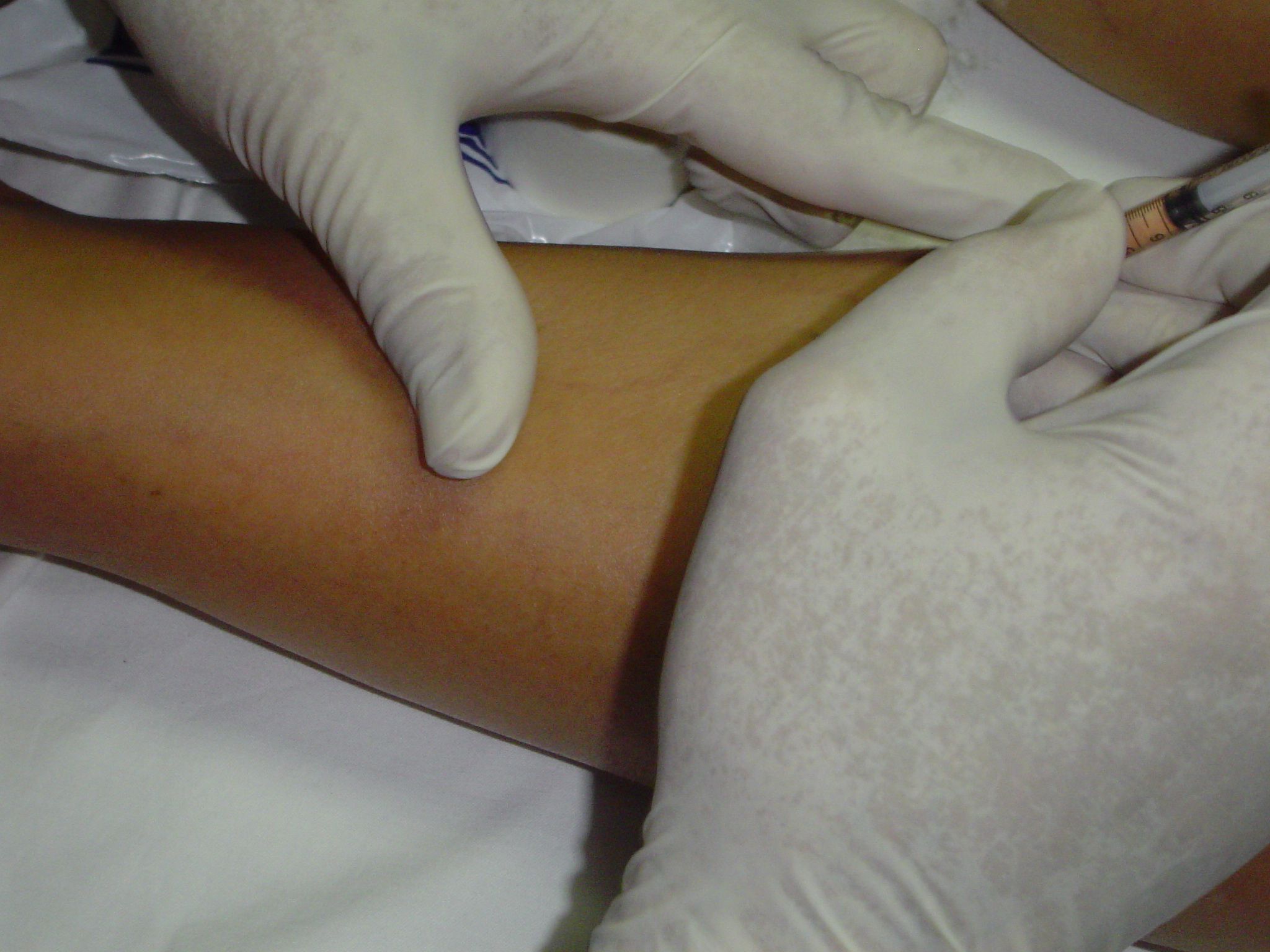 pinchar-varices