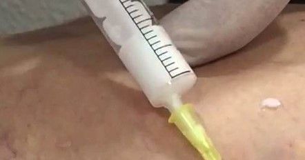 esclerosis espuma