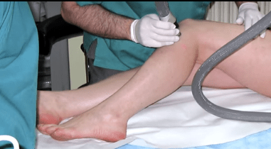 laser varices